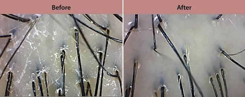 Close-up of hair and scalp before and after treatment comparison under a microscope.